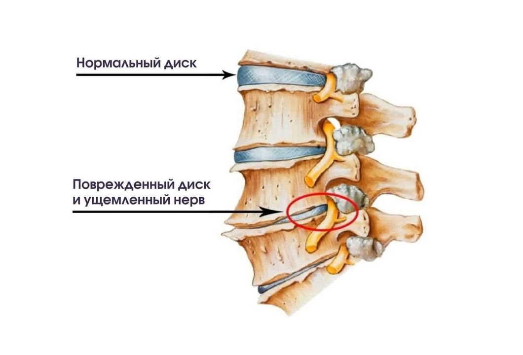 Symptomen van cervicale osteochondrose