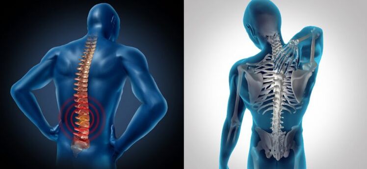 Ontsteking bij spinale osteochondrose
