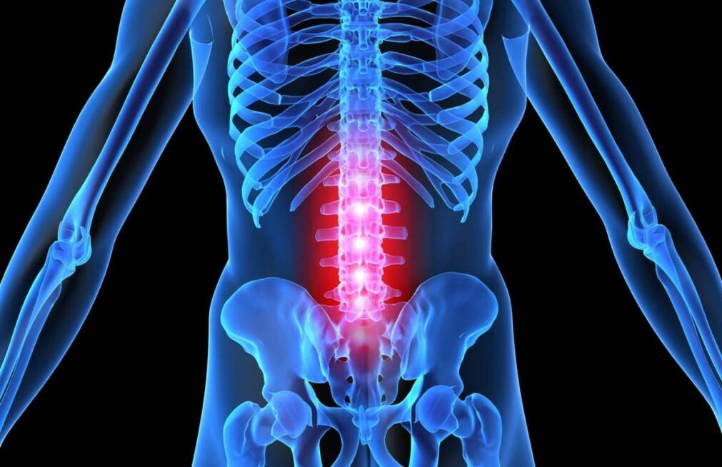 Osteochondrose van de lumbale wervelkolom