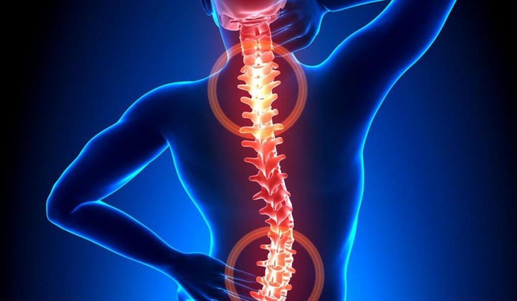 spinale osteochondrose