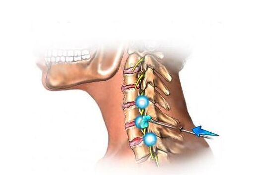 behandeling van cervicale osteochondrose